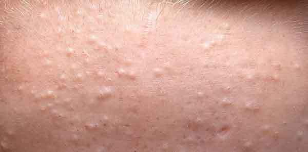 چگونه  جوش‌های زیر پوستی  را درمان کنیم ؟