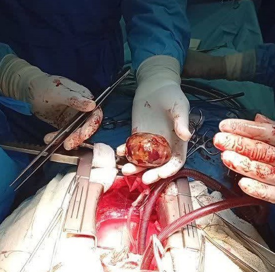 خروج توده ۸ سانتی‌متری از قلب بیمار در سبزوار